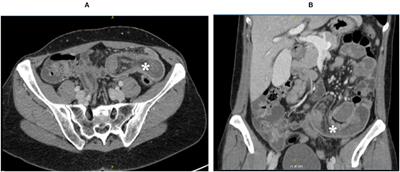 Frontiers Case Report Ileo Ileal Intussusception Secondary To